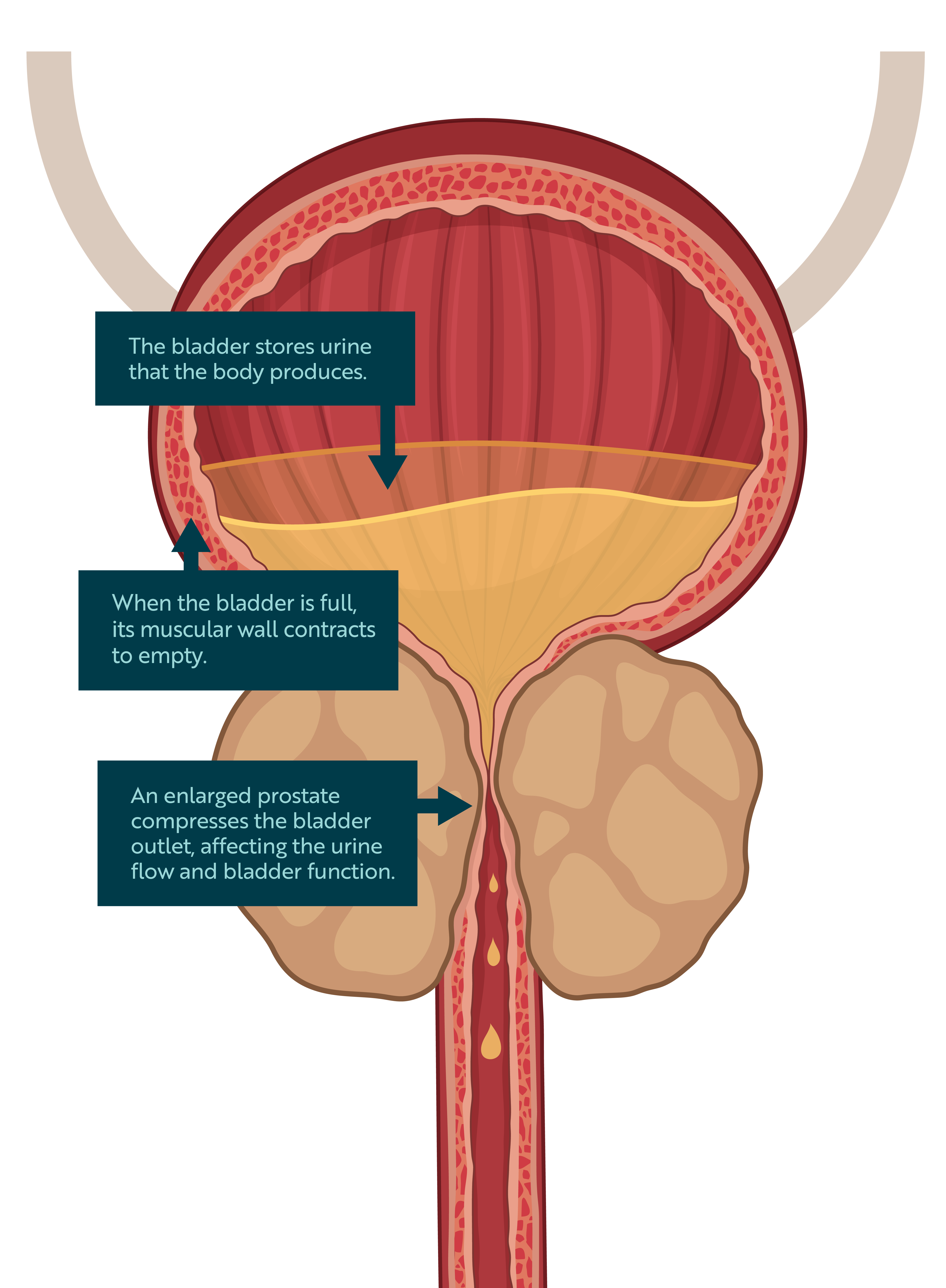 Bladder Function & Enlarged Prostate What You Need to Know SRS Medical